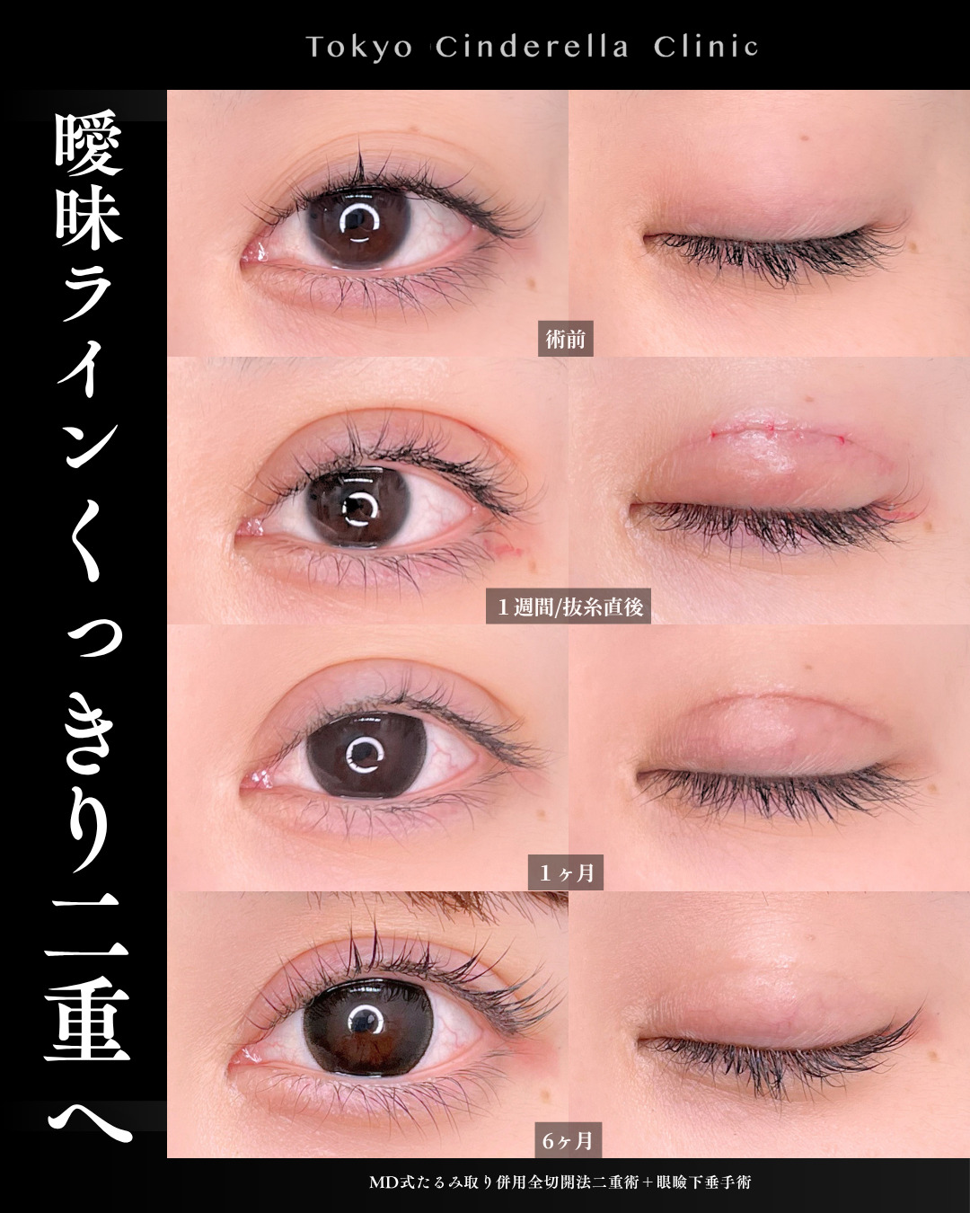眼瞼下垂の手術を受ける時の名医の探し方を医師が解説｜美容整形は東京