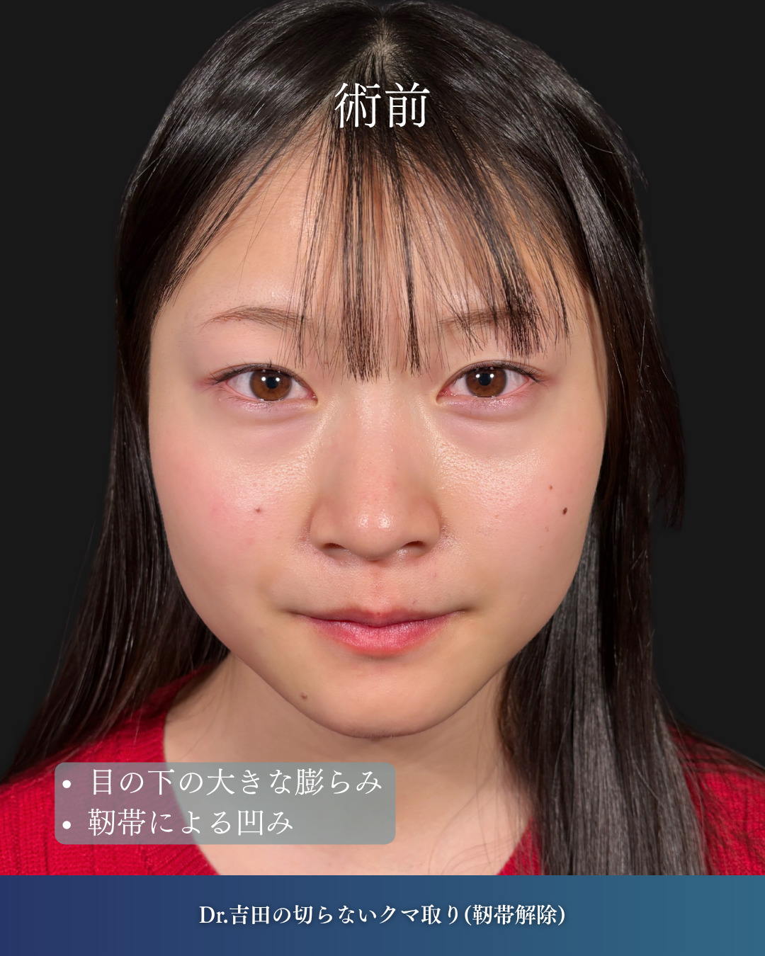 横浜院で行ったクマ取りの名医の吉田利之医師の切らないクマ取り(靭帯解除)の1ヶ月後の症例写真