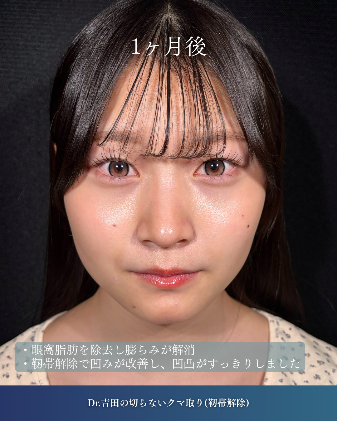 横浜院で行ったクマ取りの名医の吉田利之医師の切らないクマ取り(靭帯解除)の1ヶ月後の症例写真