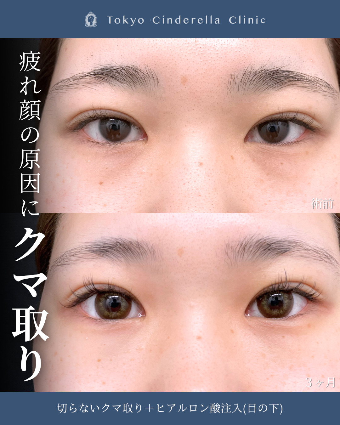 新宿院院長吉原伯執刀、切らないクマ取りとヒアルロン酸注入の３ヶ月比較
