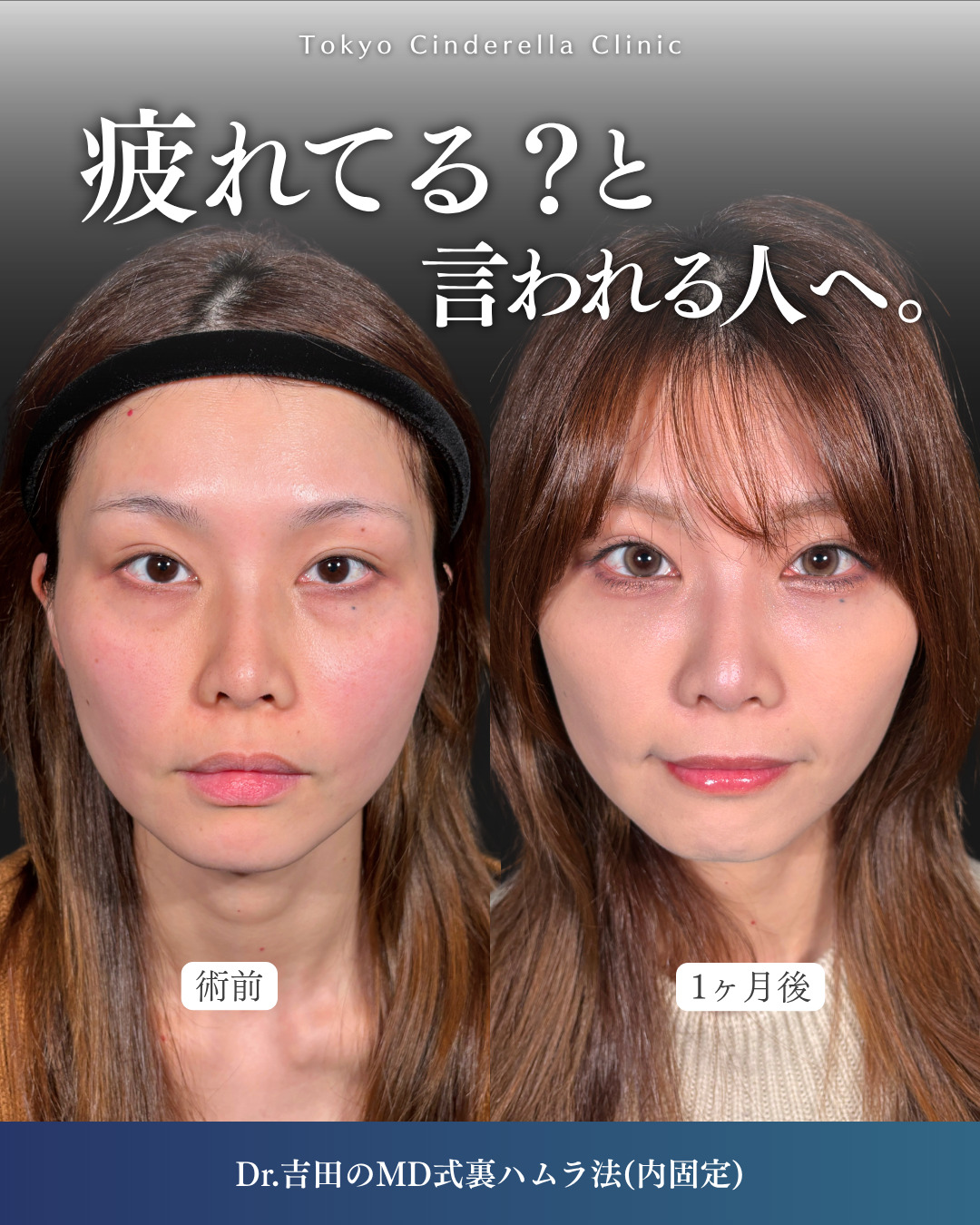 横浜院で行ったクマ取りの名医の吉田利之医師のMD式裏ハムラ法の3ヶ月後までのダウンタイム症例写真