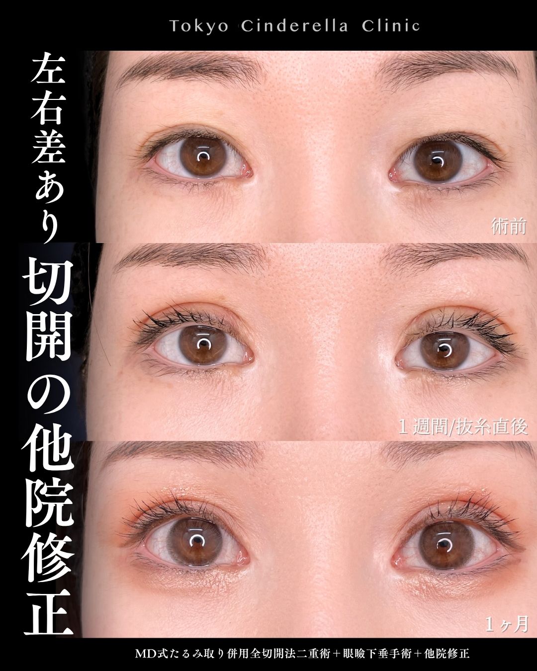 デカ目コンタクトでも映える二重 」に関する美容整形の症例写真の詳細