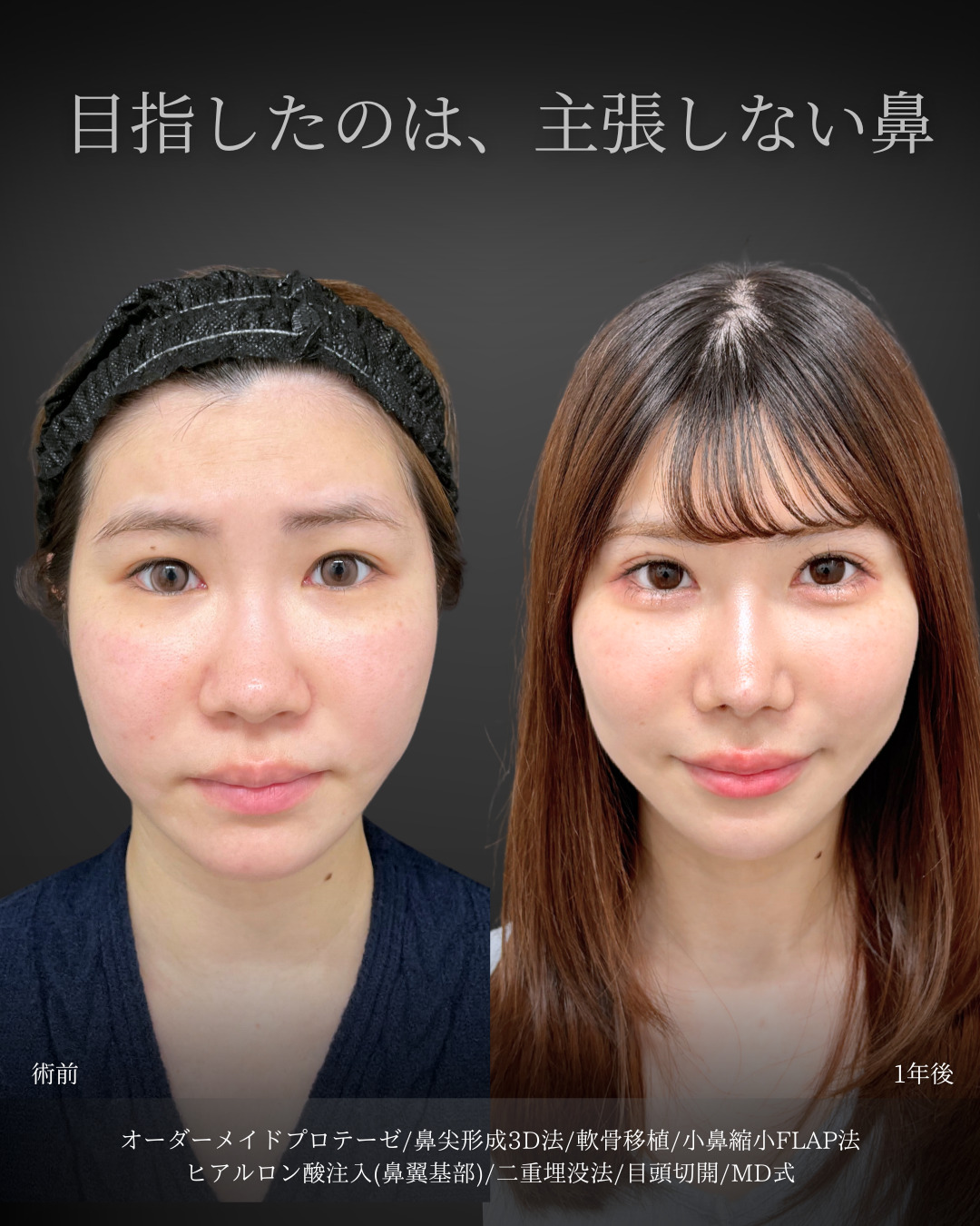 新宿院で行った鼻整形の名医の吉原伯医師の症例写真