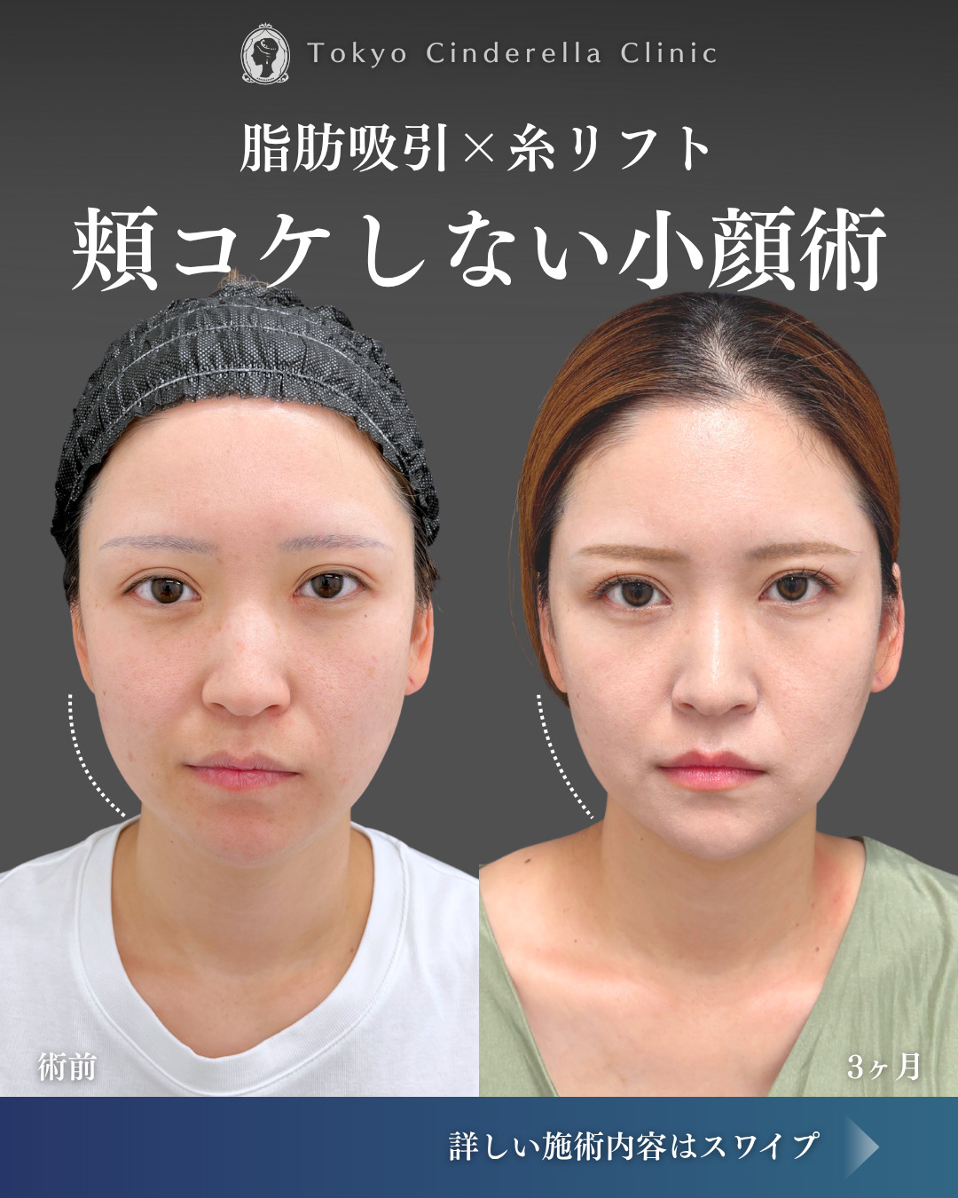 ライト脂肪吸引 の症例写真一覧｜ 新宿・池袋・大宮・横浜で人気の美容