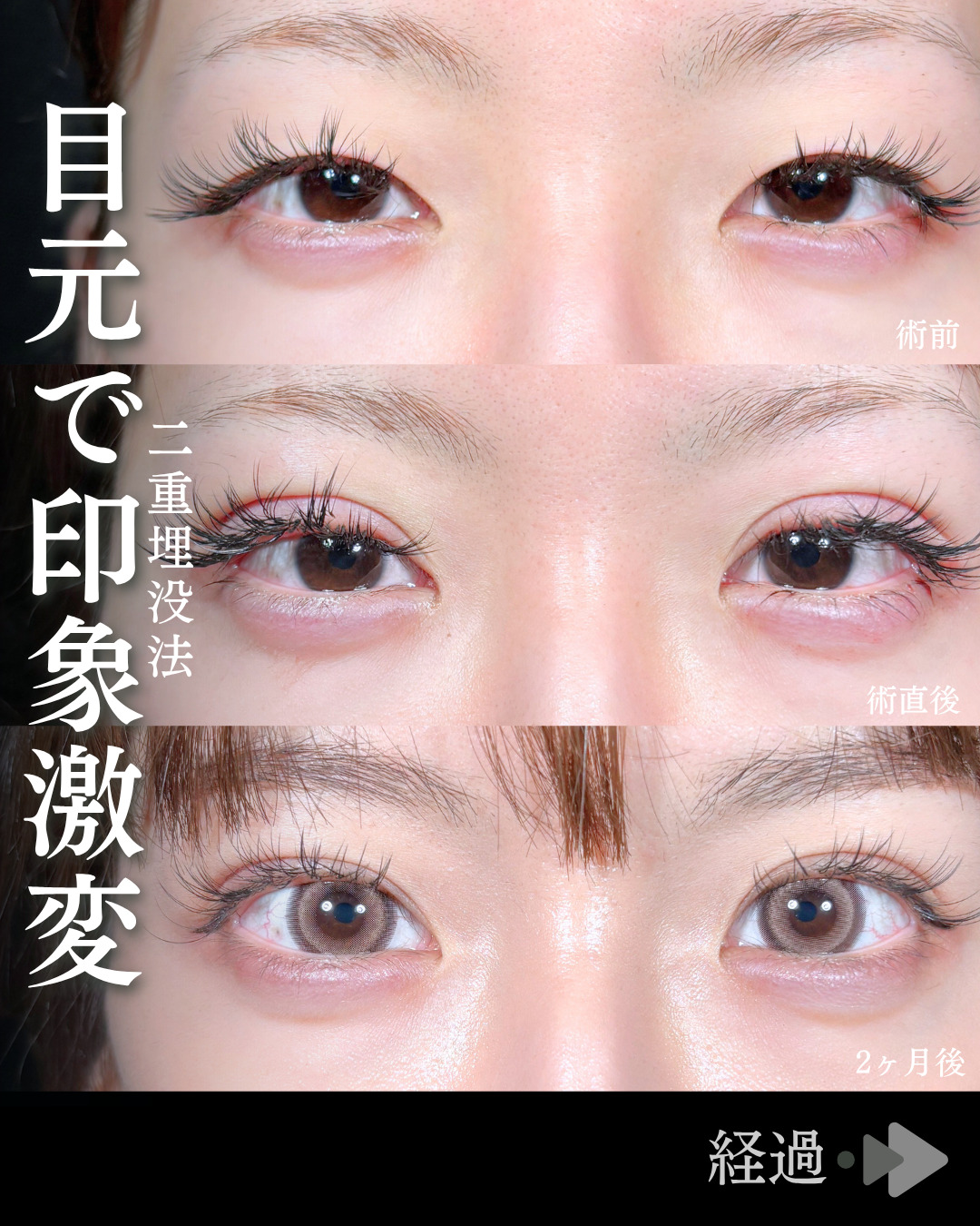 池袋院で行った二重埋没法整形で有名な石井達也医師の症例写真