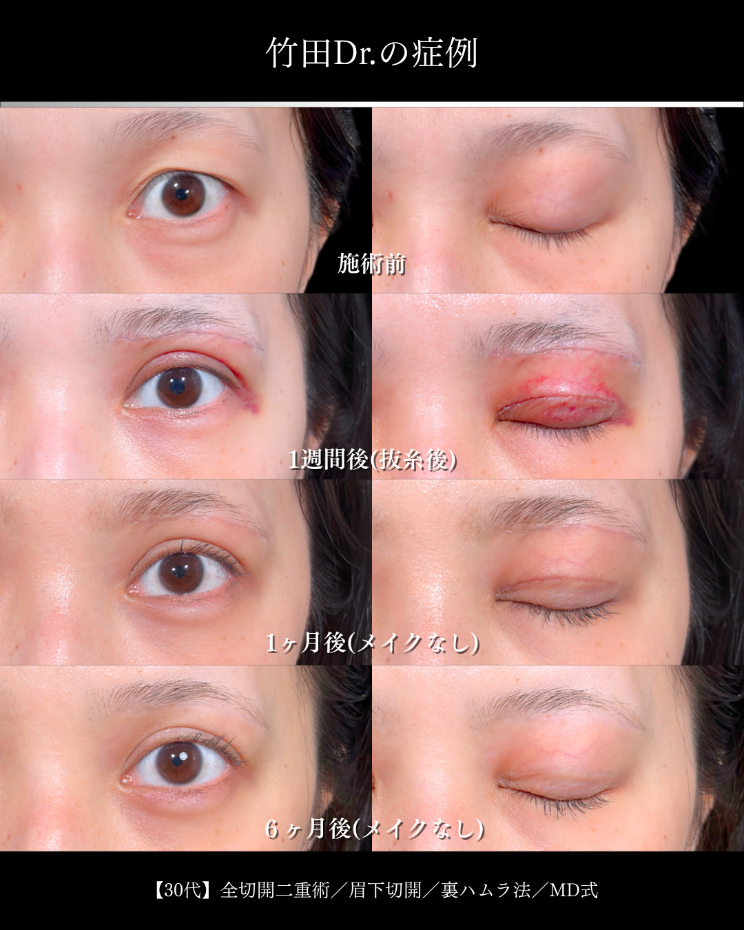 大宮院で行った二重切開と眉下切開と裏ハムラで有名な名医の竹田昌平医師の症例写真