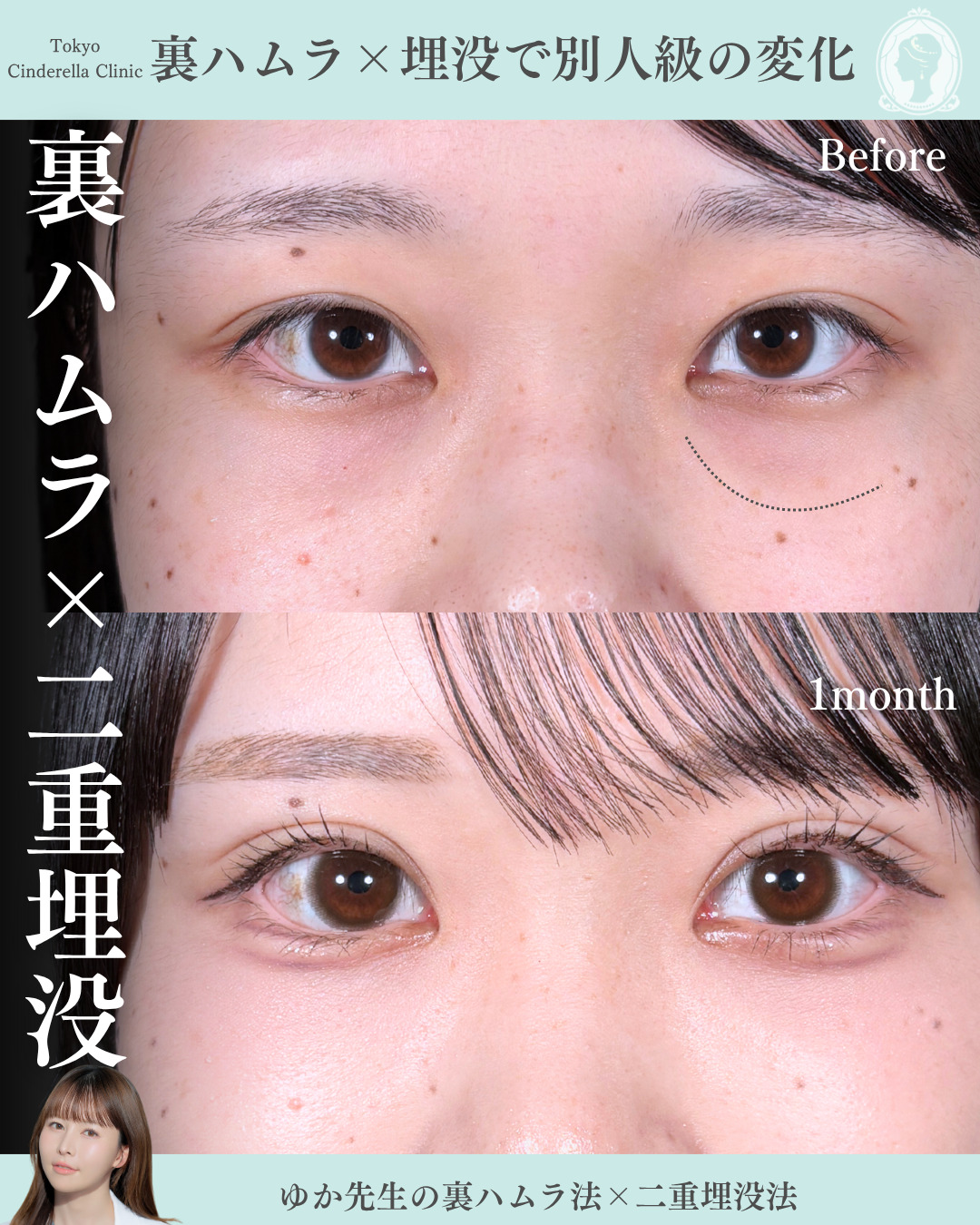 新宿院で行った目元整形で有名な宮﨑友伽医師の症例写真