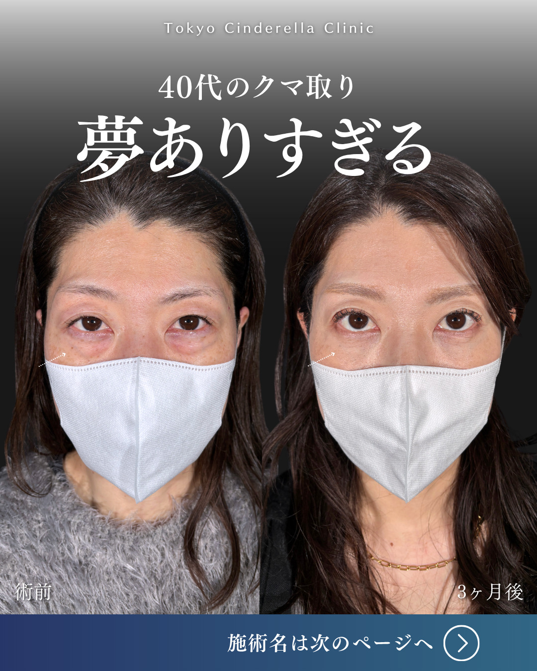 横浜院で行ったクマ取りの名医の吉田利之医師のMD式裏ハムラ法の3ヶ月後までのダウンタイム症例写真