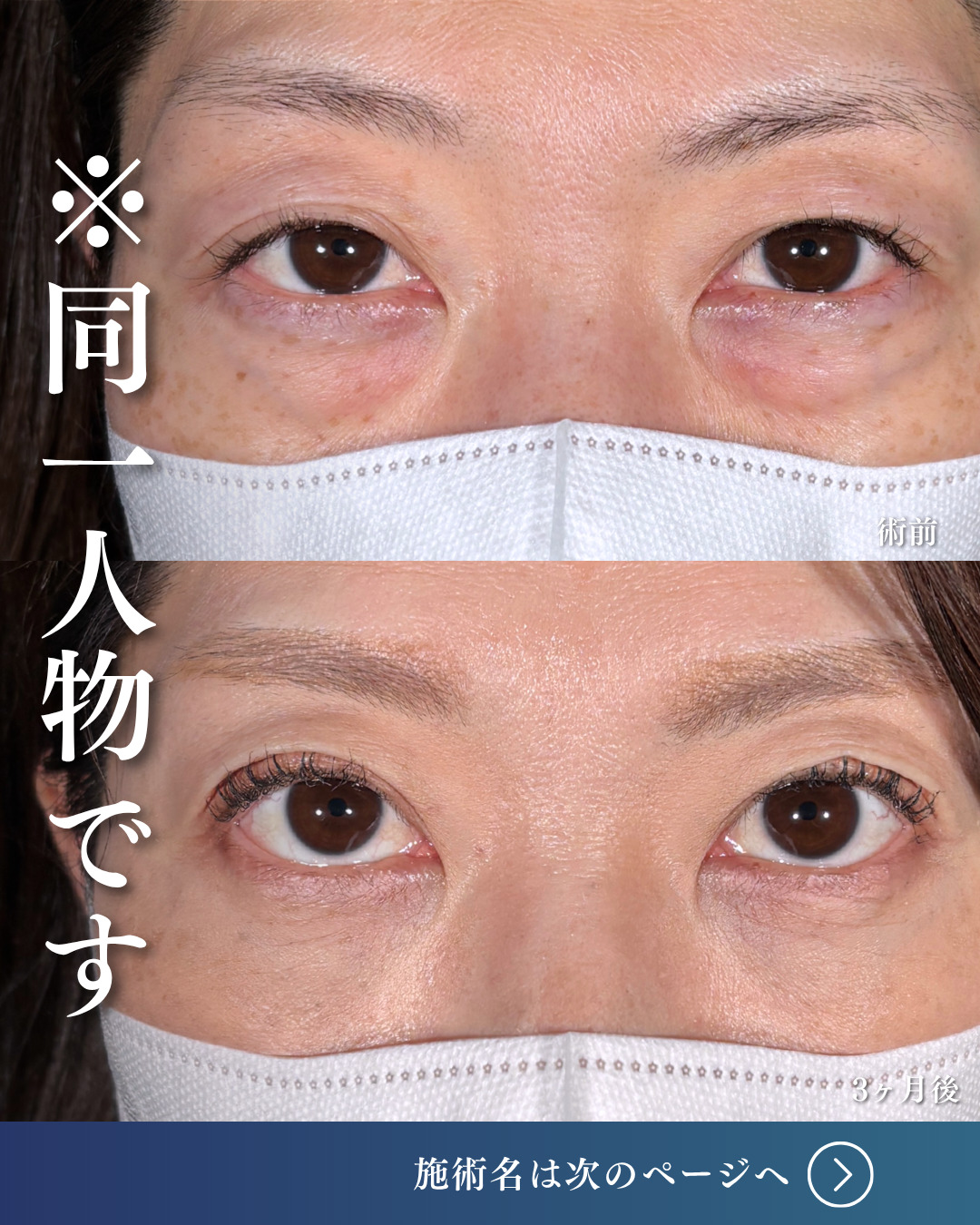 横浜院で行ったクマ取りの名医の吉田利之医師のMD式裏ハムラ法の3ヶ月後までのダウンタイム症例写真
