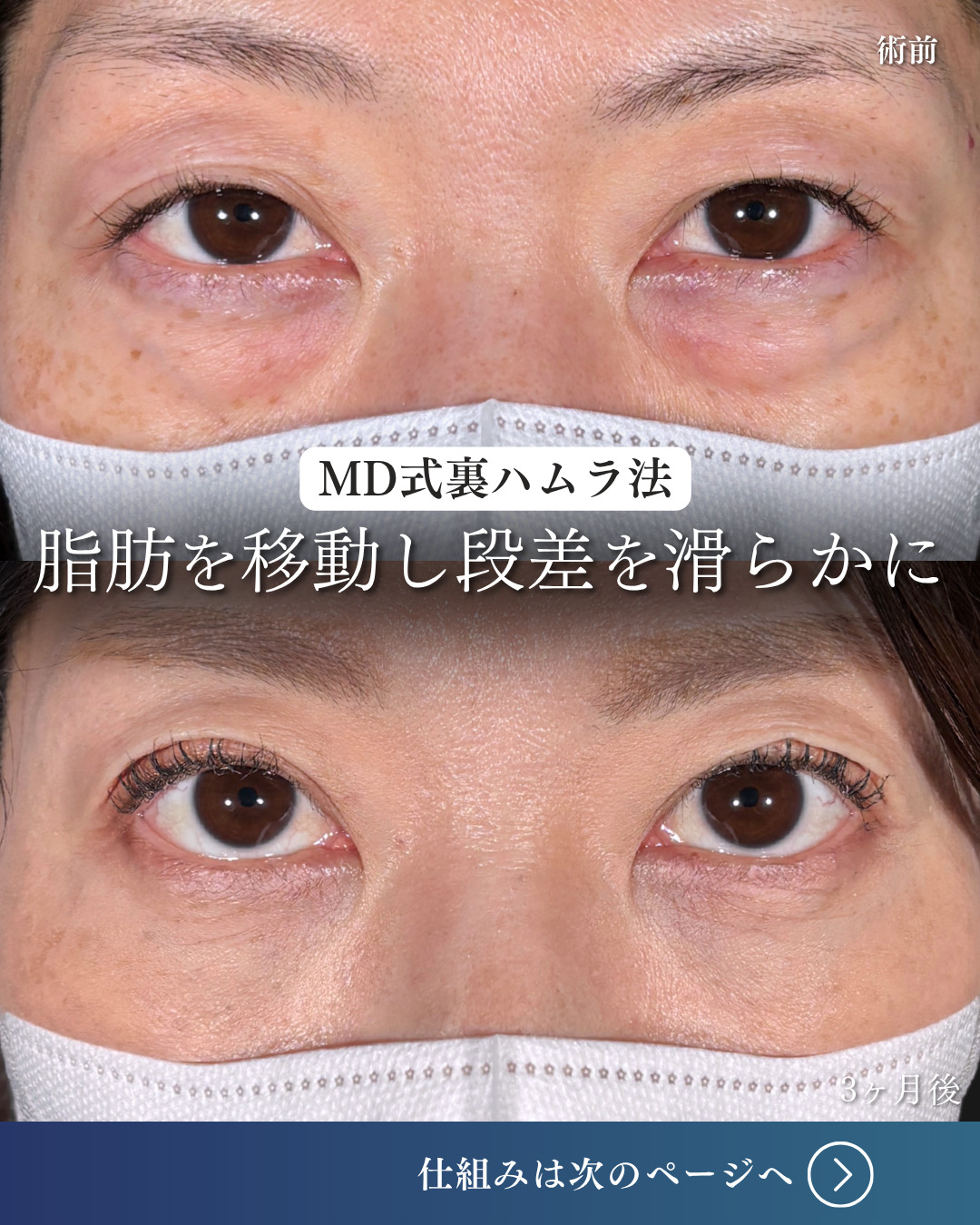 横浜院で行ったクマ取りの名医の吉田利之医師のMD式裏ハムラ法の3ヶ月後までのダウンタイム症例写真