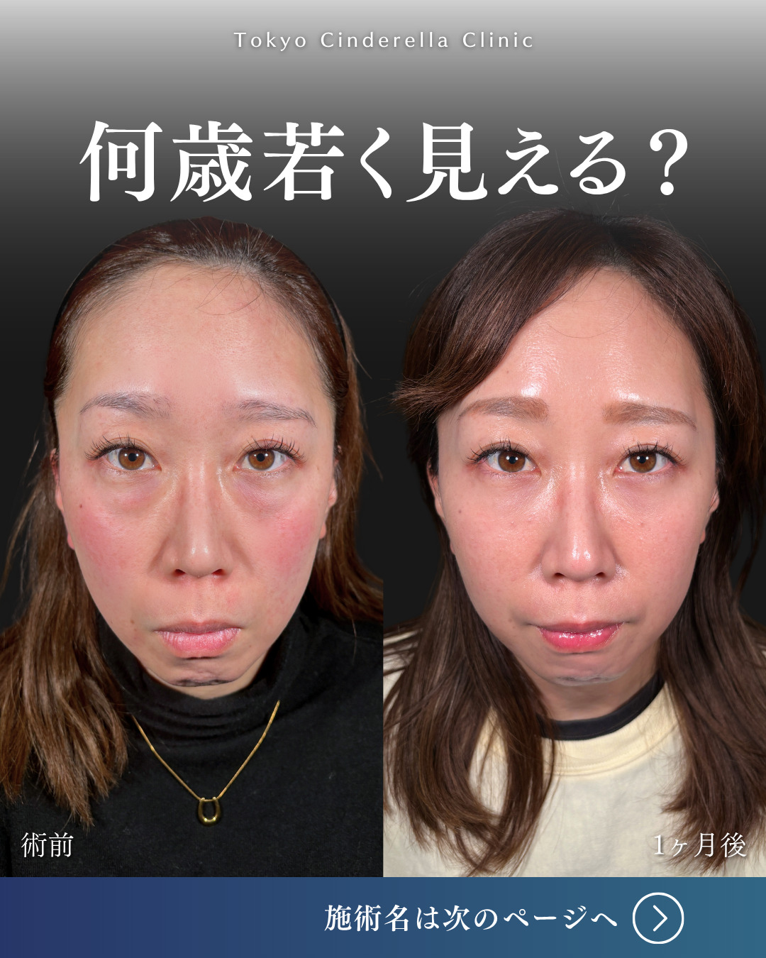 横浜院で行ったクマ取りの名医の吉田利之医師のMD式裏ハムラ法の1ヶ月後の症例写真