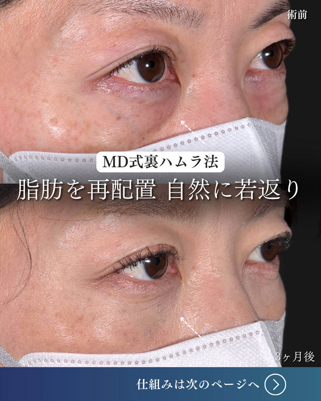 横浜院で行ったクマ取りの名医の吉田利之医師のMD式裏ハムラ法の3ヶ月後までのダウンタイム症例写真