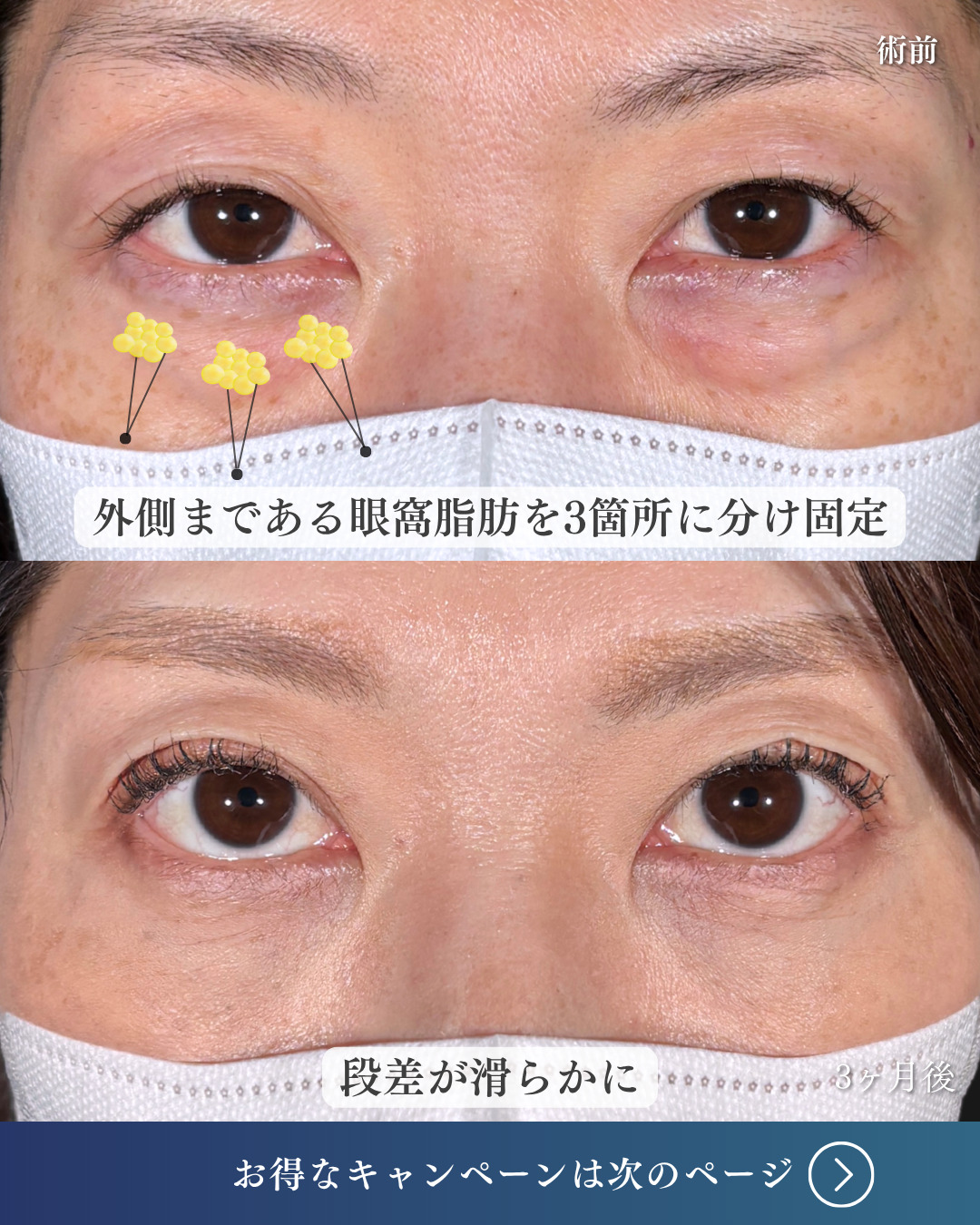 横浜院で行ったクマ取りの名医の吉田利之医師のMD式裏ハムラ法の3ヶ月後までのダウンタイム症例写真
