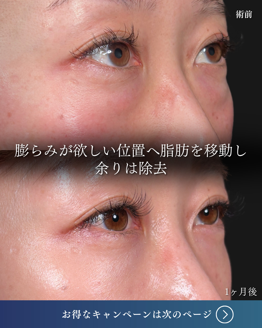 横浜院で行ったクマ取りの名医の吉田利之医師のMD式裏ハムラ法の1ヶ月後の症例写真