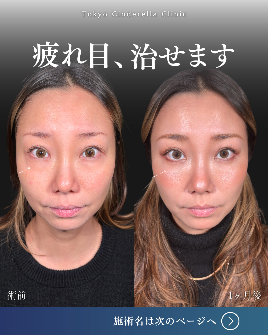 横浜院で行ったクマ取りの名医の吉田利之医師の切らないクマ取りと目の下のヒアルロン酸注入の3ヶ月後までのダウンタイム症例写真