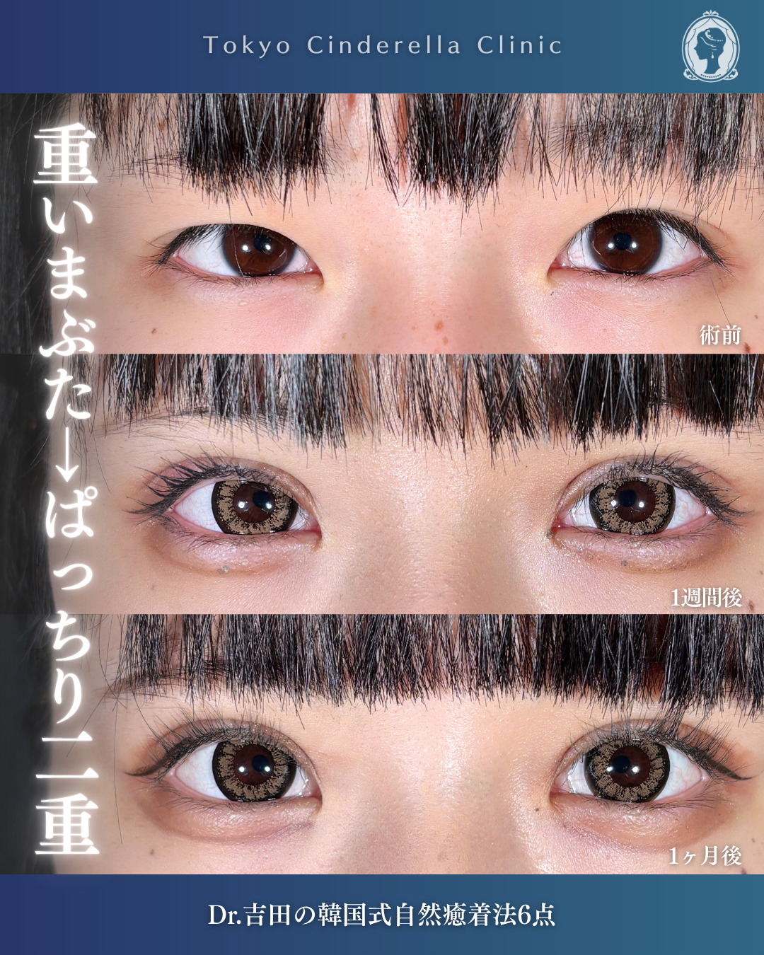 眼瞼下垂手術で目の開き改善 」に関する美容整形の症例写真の詳細