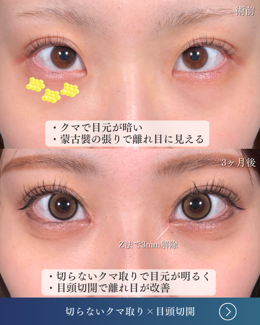 二重幅 二重幅9mm 」に関する美容整形の症例写真の詳細 | 新宿・池袋・大宮