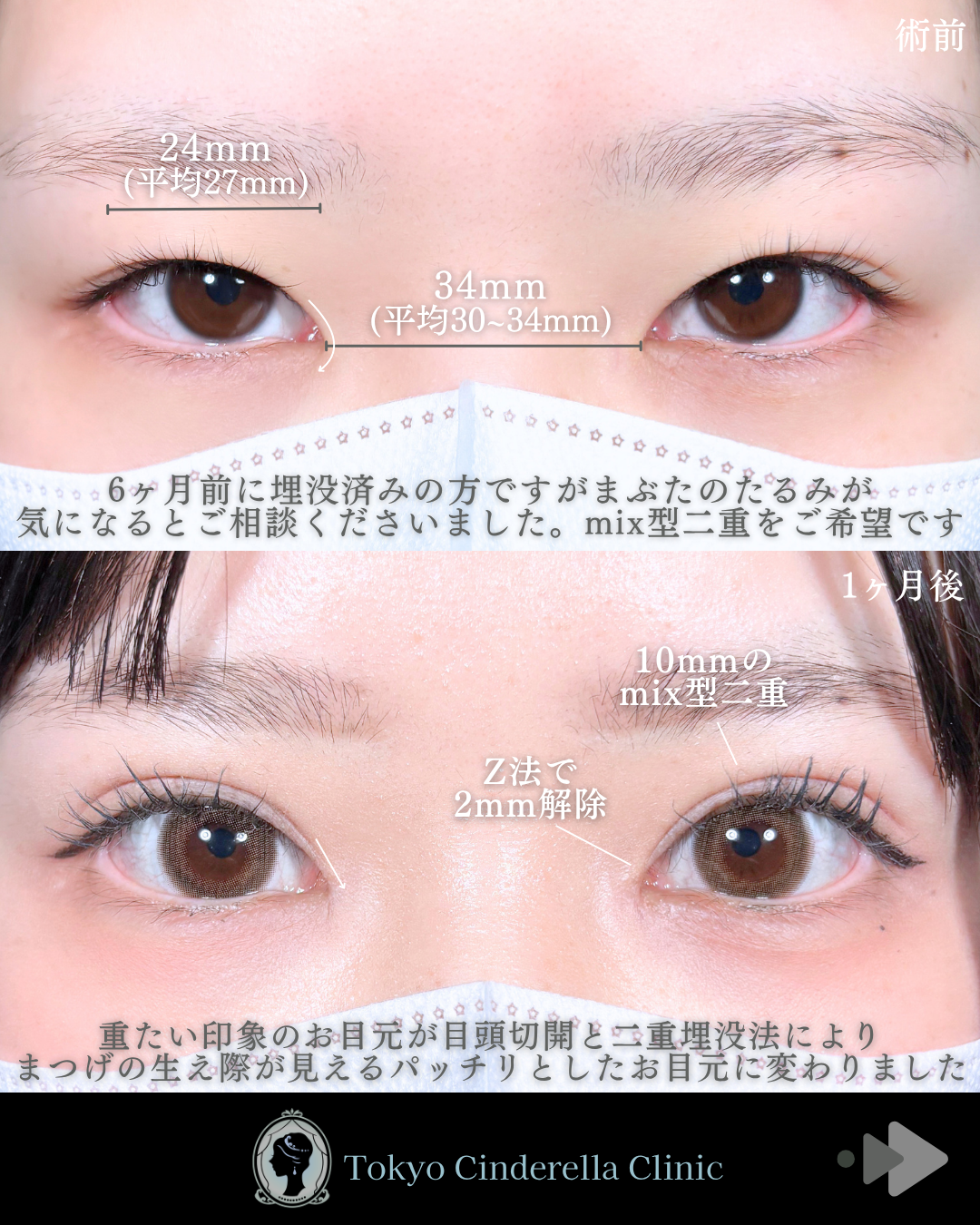 二重幅9mm 」に関する美容整形の症例写真の詳細 | 新宿・池袋・大宮