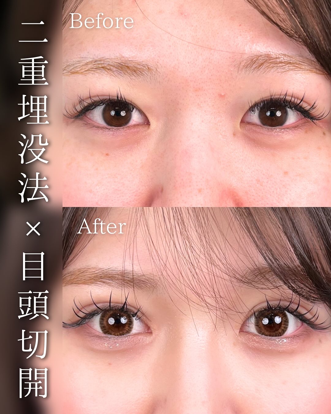 東京シンデレラ美容外科の美容外科歴18年以上の美容外科専門医の吉原伯が施術した二重埋没の症例