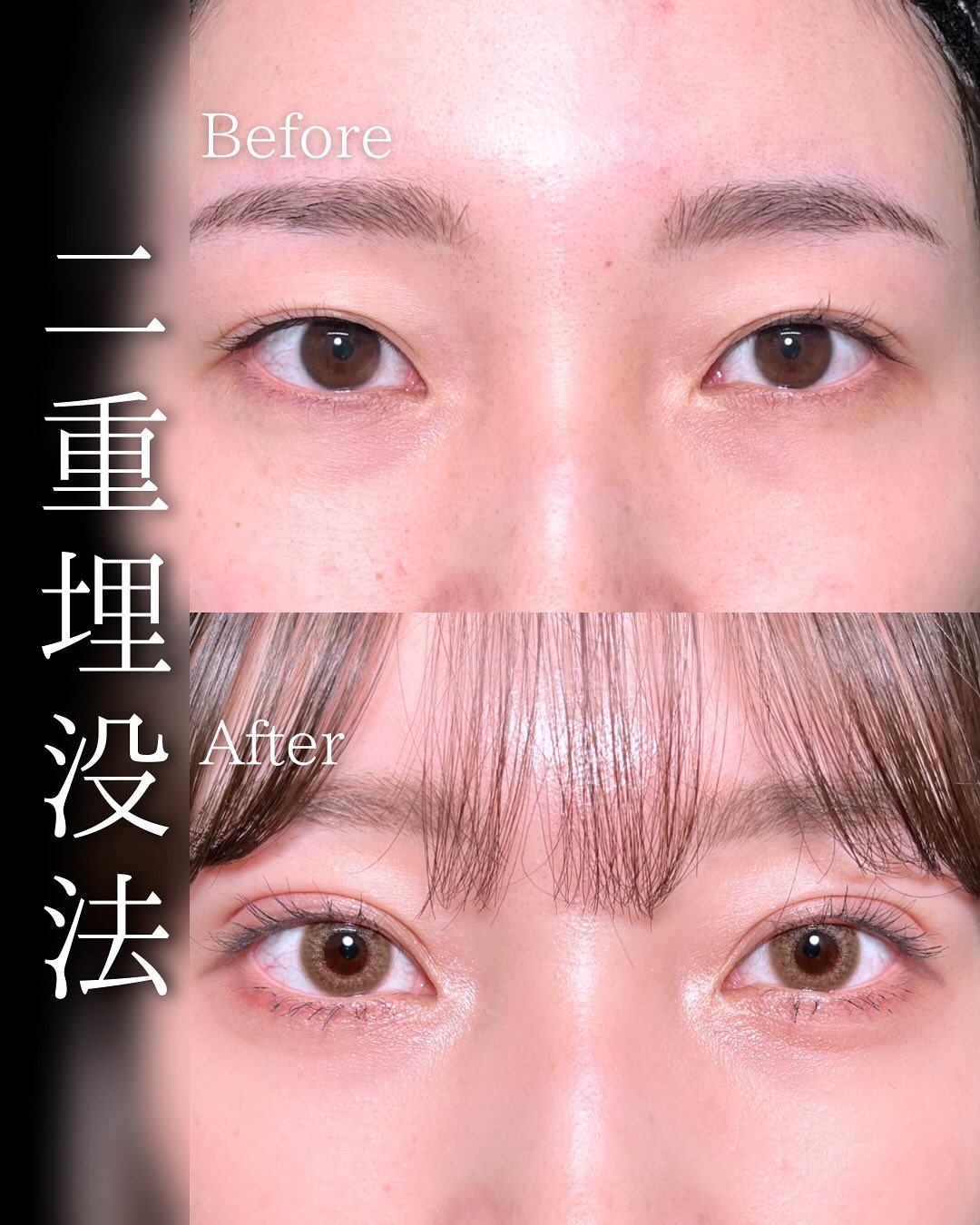 東京シンデレラ美容外科の美容外科歴18年以上の美容外科専門医の吉原伯が施術した二重埋没の症例