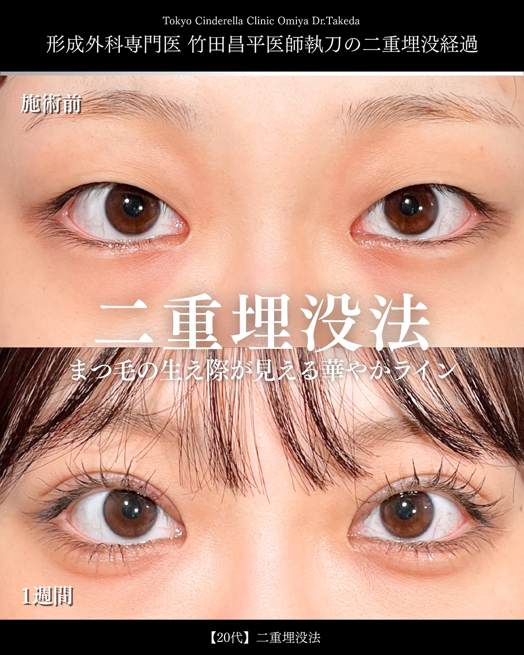 東京シンデレラ美容外科の美容外科歴18年以上の美容外科専門医の吉原伯が施術した二重埋没の症例