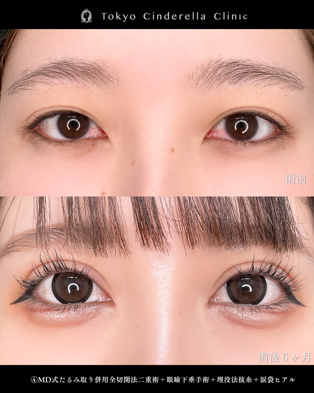 東京シンデレラ美容外科の美容外科歴18年以上の美容外科専門医の吉原伯が施術した二重切開の症例