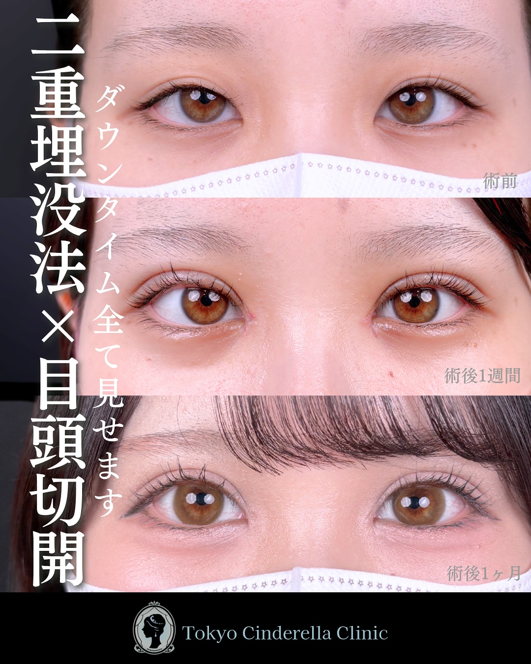 東京シンデレラ美容外科の美容外科歴18年以上の美容外科専門医の吉原伯が施術した二重埋没の症例