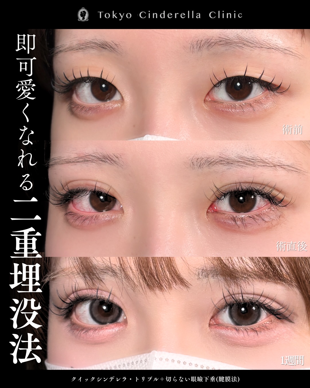 東京シンデレラ美容外科の美容外科歴18年以上の美容外科専門医の吉原伯が施術した二重埋没の症例