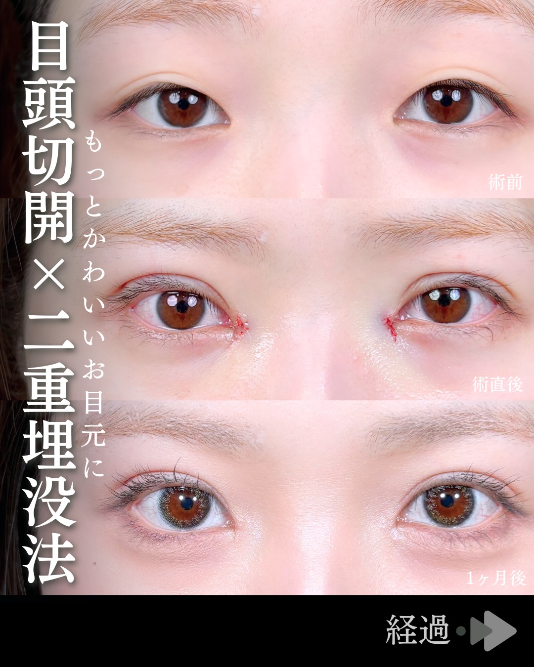 東京シンデレラ美容外科の美容外科歴18年以上の美容外科専門医の吉原伯が施術した二重埋没の症例