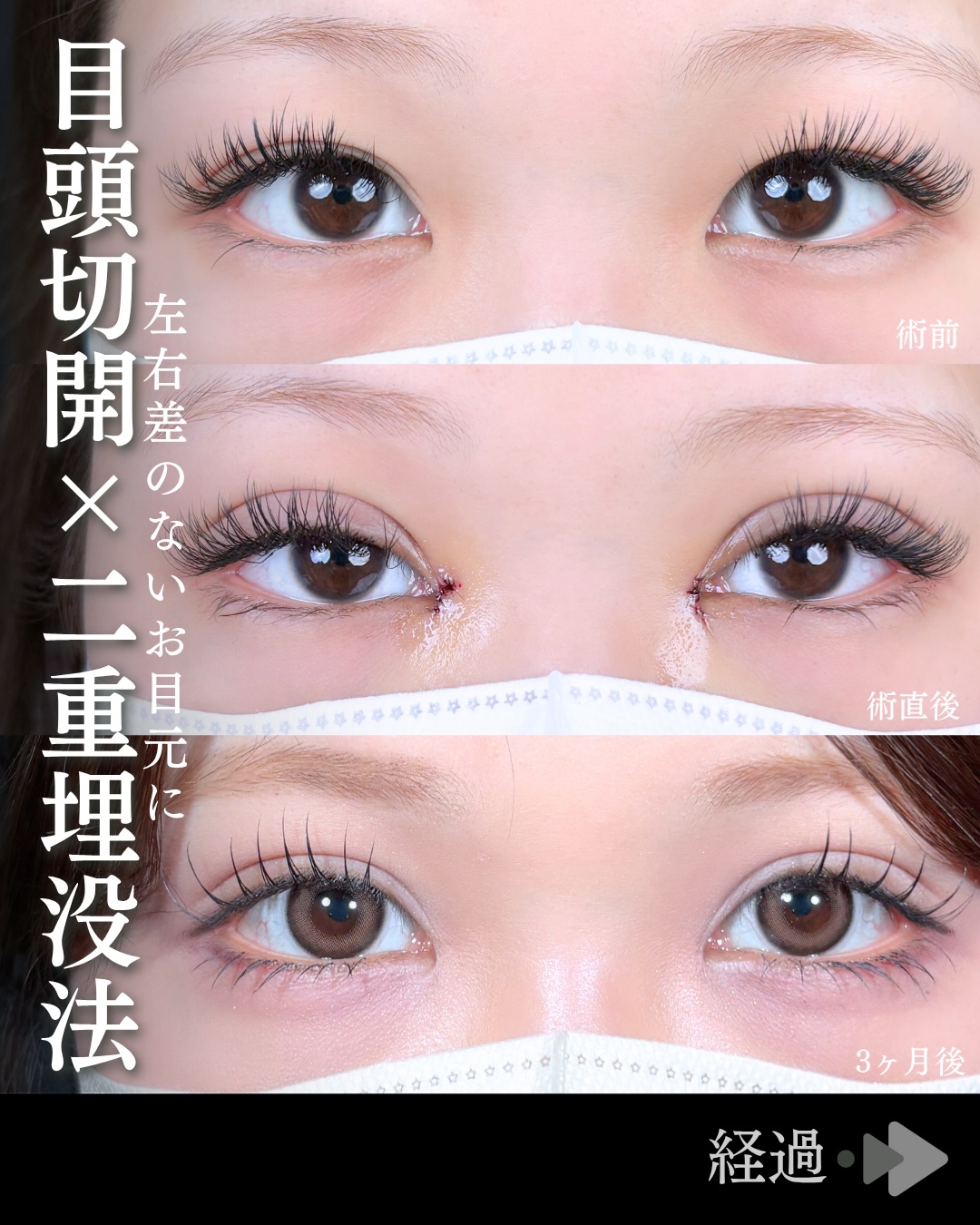 東京シンデレラ美容外科の美容外科歴18年以上の美容外科専門医の吉原伯が施術した二重埋没の症例