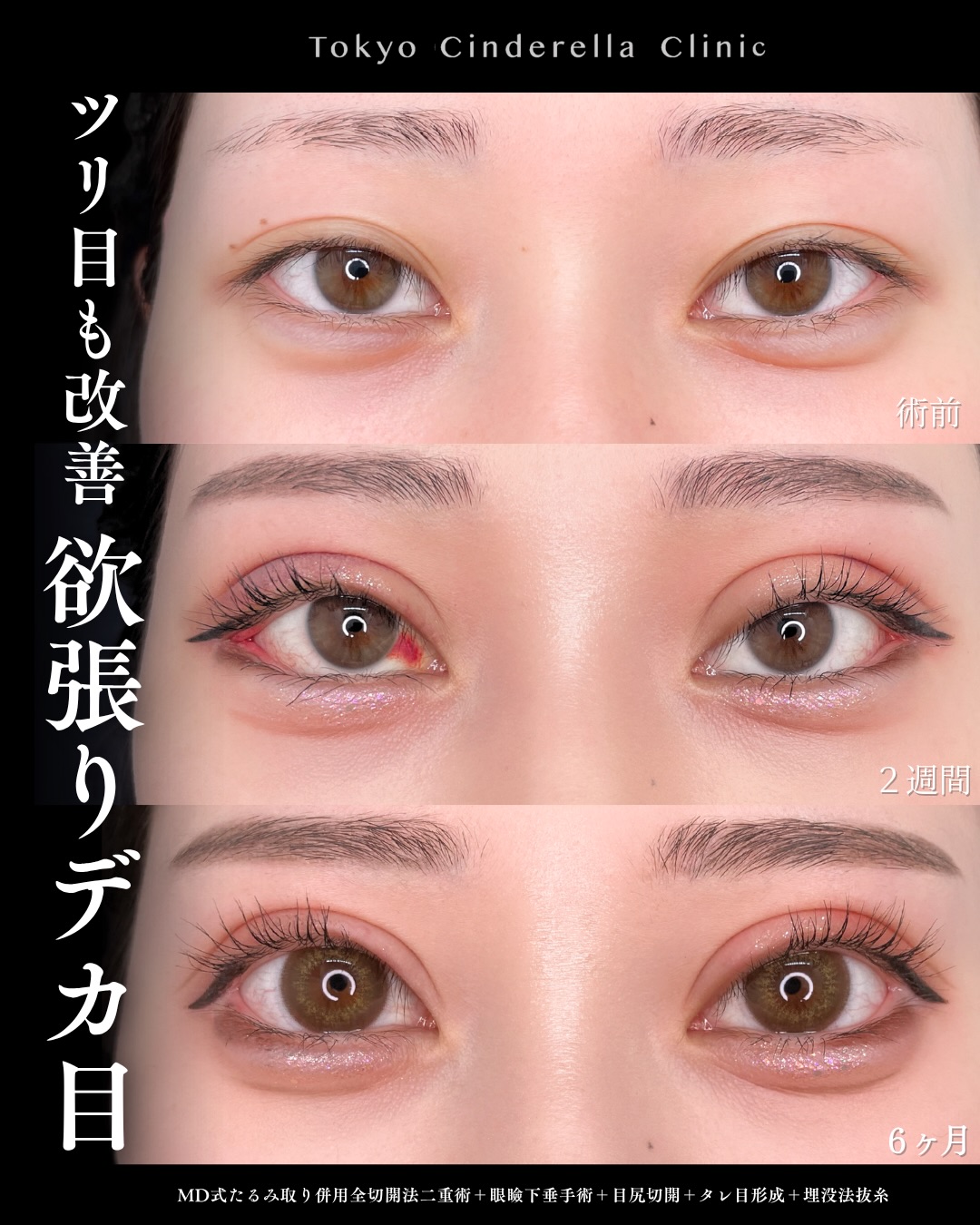 東京シンデレラ美容外科の美容外科歴18年以上の美容外科専門医の吉原伯が施術した二重切開の症例