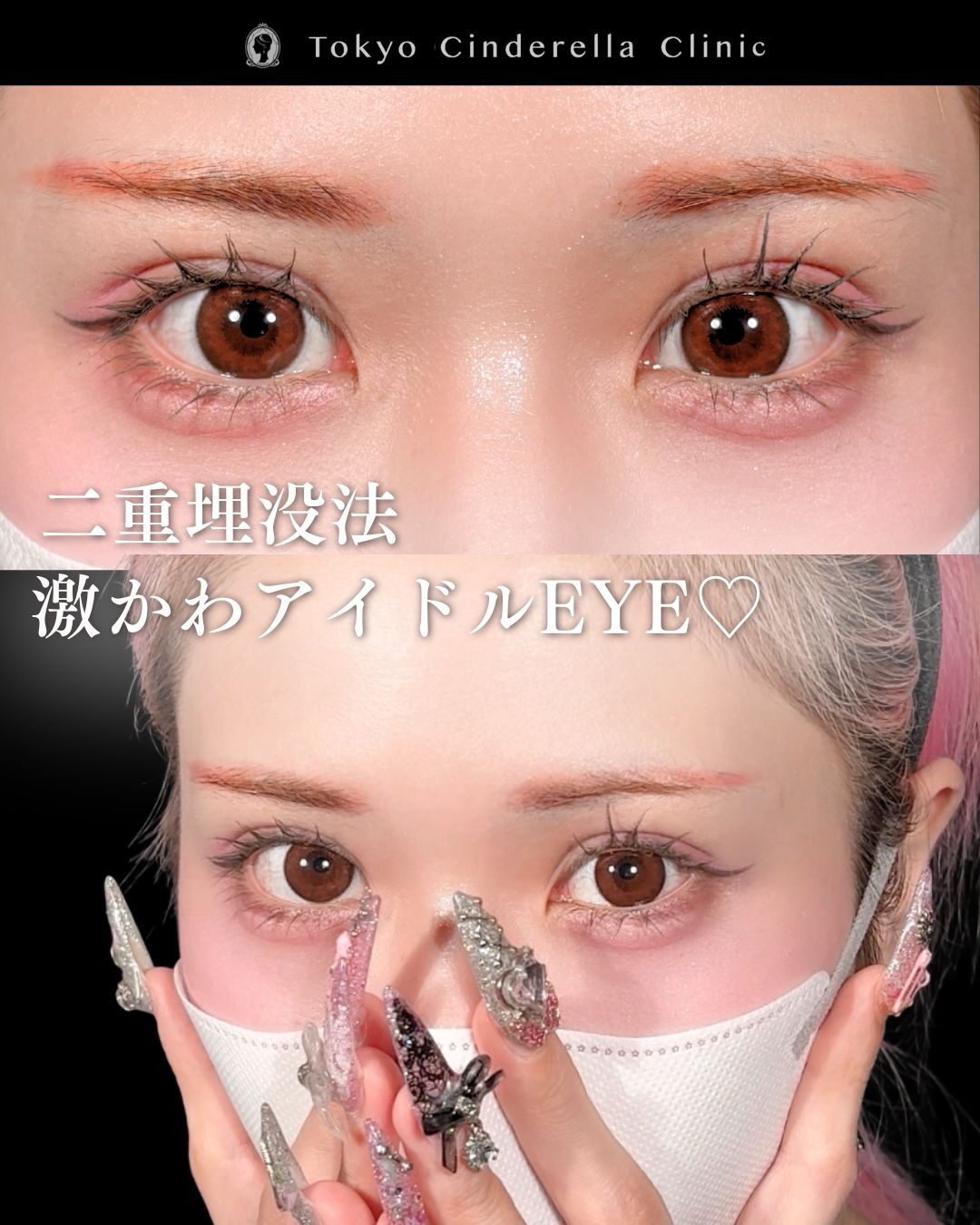 東京シンデレラ美容外科の美容外科歴18年以上の美容外科専門医の吉原伯が施術した二重切開の症例