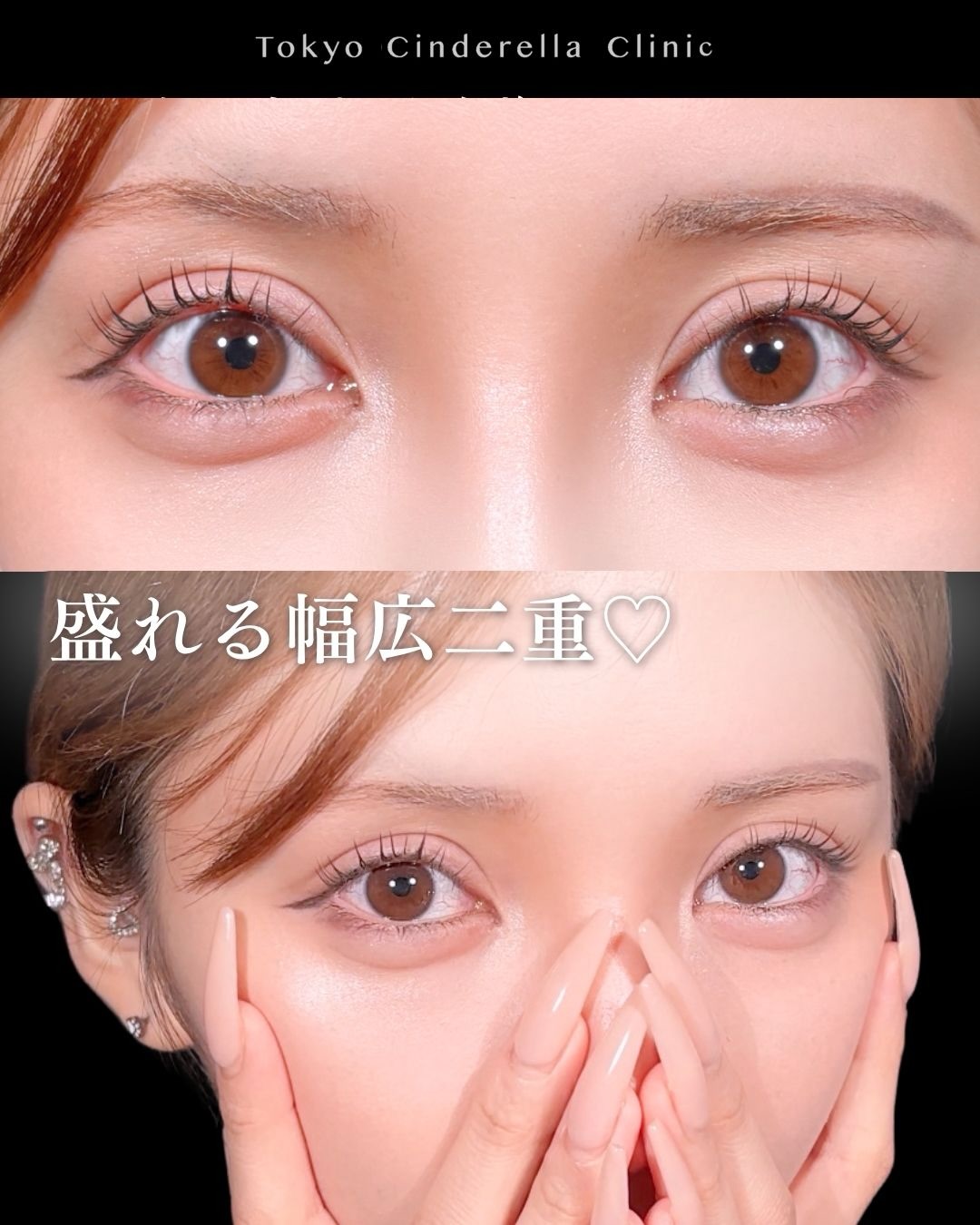 東京シンデレラ美容外科の美容外科歴18年以上の美容外科専門医の吉原伯が施術した二重切開の症例