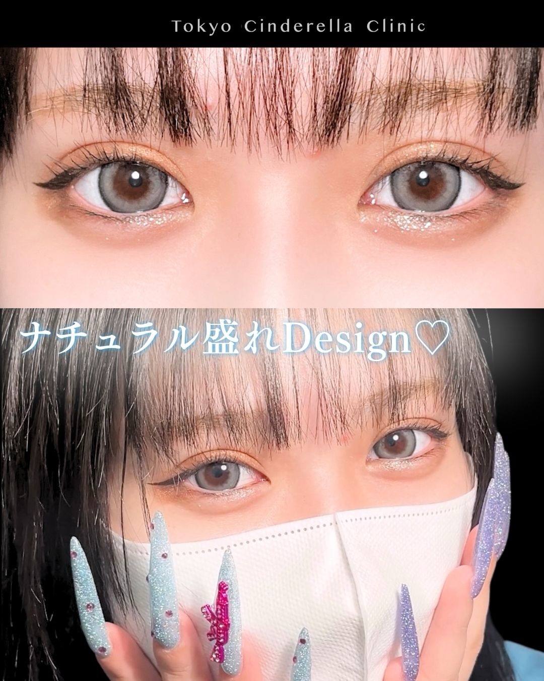 東京シンデレラ美容外科の美容外科歴18年以上の美容外科専門医の吉原伯が施術した二重切開の症例