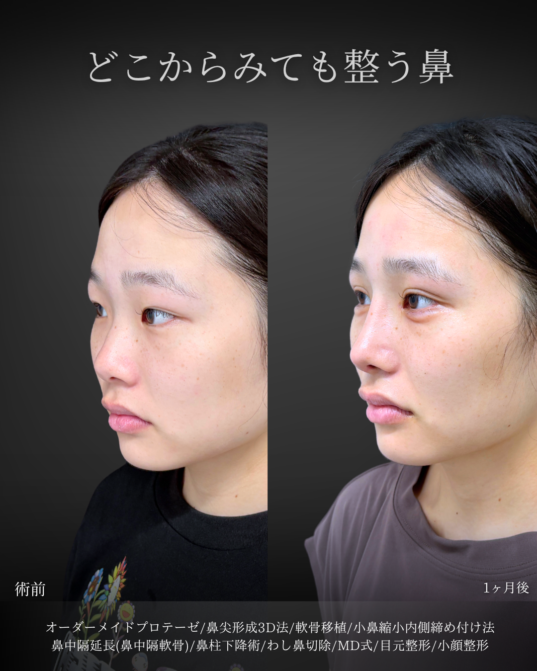 目頭側から自然に平行 」に関する美容整形の症例写真の詳細 | 新宿